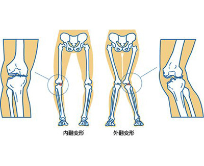 缺维生素D导致腿部变形