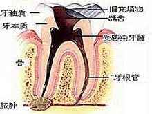 颌骨骨髓炎