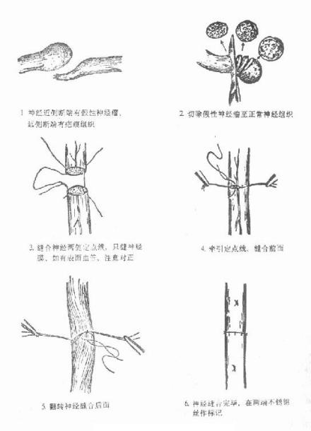 神经损伤