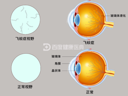 飞蚊症患者视野与正常视野比较